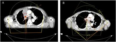 Predicting radiation pneumonitis in lung cancer: a EUD-based machine learning approach for volumetric modulated arc therapy patients